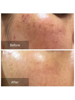 ポムポムボナー/どんどん増えてしまったシミケア