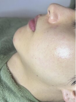 イベリス(Iberis)の写真/【多くの男性のお客様にもご来店される信頼サロン！】肌悩みを改善し、長年のコンプレックスを解消！