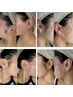 【女性】『もみあげW+うなじW脱毛』ワックス脱毛＋光脱毛 