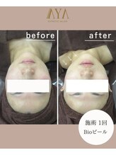 アヤエステティックサロン 綱島店(AYA)/目指せ！陶器肌♪