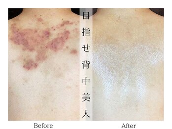 リララ(lelala)/夏までに背中ケア