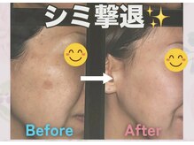 サロン ド ピュール(SALON DE PURE)/レチノールピール/シミケア/浜松