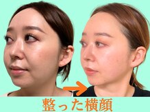 ナチュラルパーフェクトフェイス 新宿/歪みは横顔に出る/新宿小顔矯正
