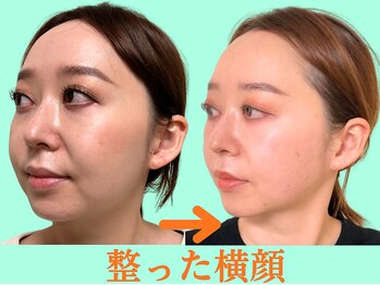 ナチュラルパーフェクトフェイス 新宿/歪みは横顔に出る/新宿小顔矯正