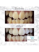 ホワイトニングショップ 秋田店/【before after】 美白