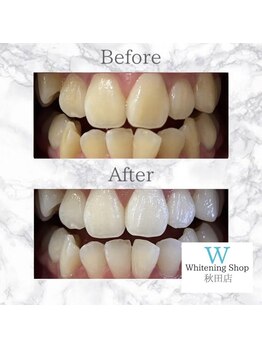 ホワイトニングショップ 秋田店/【before after】 美白