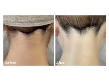 メイ(meiy)/脱毛/えり足/うなじ