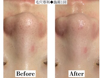フレイヤ(FREYA)/毛穴専科Before→After