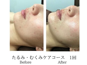 メンズミーシェ(Men's Meshie)/小顔フェイシャル