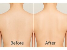 エデン(Eden)/背中ワックス脱毛