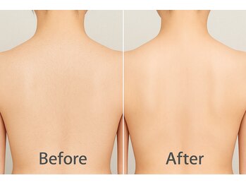 エデン(Eden)/背中ワックス脱毛