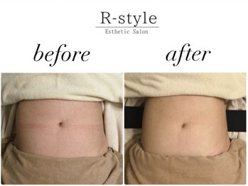 エステサロン アールスタイル(R-style)/テスラスカルプトビフォア写真