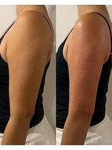 ウナ 西中島店(UNA)/新導入★マイクロ波痩身