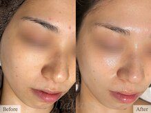 ティアラッシュ(TiaLash)/REVI陶肌トリートメント