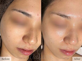 ティアラッシュ(TiaLash)/REVI陶肌トリートメント