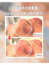 エステサロン 凛/毛穴の黒ずみがずっと気になって