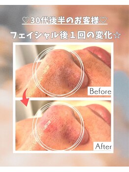 エステサロン 凛/毛穴の黒ずみがずっと気になって