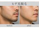 シュガーリングハウス ベル(Bell)の写真/【メンズ脱毛も大歓迎】清潔感は脱毛で整える!毎朝のヒゲ剃りをもっとラクに。各パーツごとの脱毛も可能◎