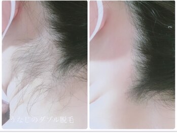 サロン ド モア(salon de MORE)/うなじのダブル脱毛
