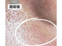 リッカロッカ(RIKKA&ROCCA)/施術後