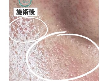 リッカロッカ(RIKKA&ROCCA)/施術後