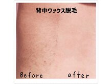 フィオーレ/スキンケア脱毛♪1回の施術でOK!