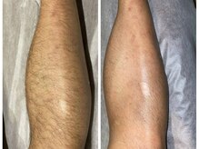 レジュ(RE:JU)の雰囲気（男性の濃い毛にもしっかり効く結果出しマシンを導入★）