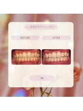 プラスビー 2号店(+b)/ホワイトニングビフォーアフター