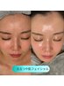 【6月限定】紫外線対策徹底美白ケア×白玉つや肌フェイシャル