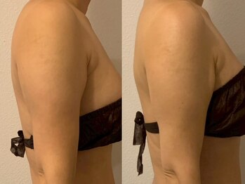 グランディール(GRANDIR)/脂肪分解セラム×4つの痩身機器