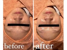 エムフルール 吹田市/フェイスラインスッキリ