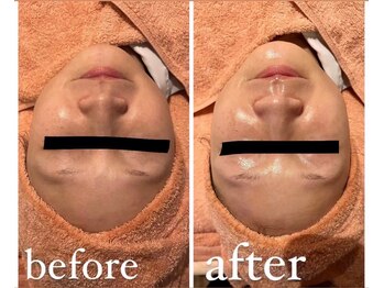 エムフルール 吹田市/フェイスラインスッキリ