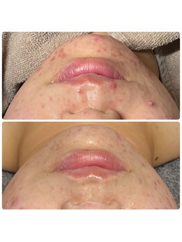 ラナ(Lana)/革命的なフェイシャル1回の結果