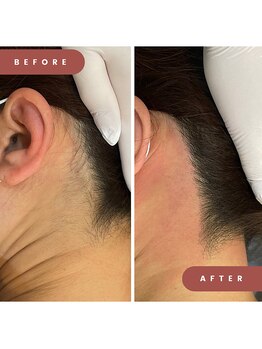 ルナビー 銀座店(Lunaby)/うなじシュガーリング