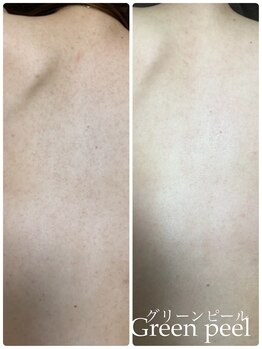 オアジスパ(Oasi Spa)/広範囲なサメ肌改善に◎