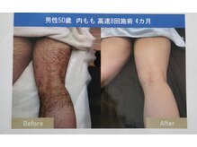 クローバー(clover)/足脱毛