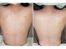 カランコエ(KALANCHOE)/背中の赤みトラブルにも