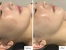 【超小顔術】カーボキシー炭酸パック＋本格韓国式バンテージ