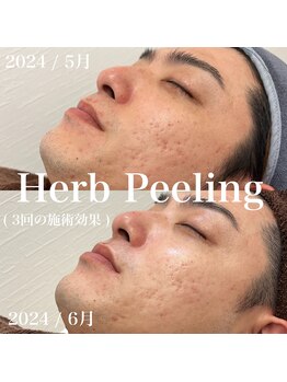 イロハ(IROHA)/ヒト幹細胞ピーリング×プラズマ