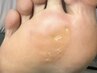 【タコ・魚の目】30分ケアし放題一律価格  ¥5,500