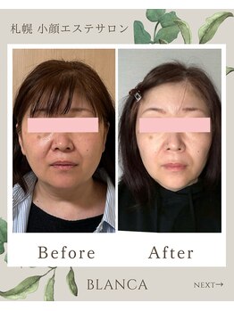 ブランカ(BLANCA)/小顔セラピアビフォーアフター
