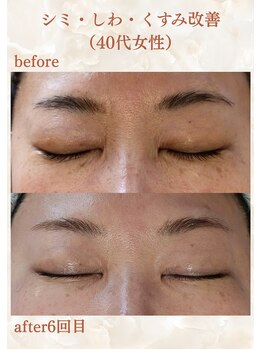 スリーエッセンス(3THREE ESSENCE)の写真/目元・口元のシワ/顔全体のたるみ/開いてしまった毛穴/頬のシミなどにアプローチ!１トーン明るい輝く肌に◎