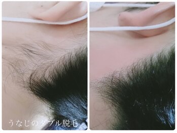 サロン ド モア(salon de MORE)/うなじのダブル脱毛