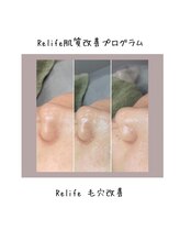 トータルビューティ リライフ(Total beauty Relife)/エクソソームと水素水ピーリング