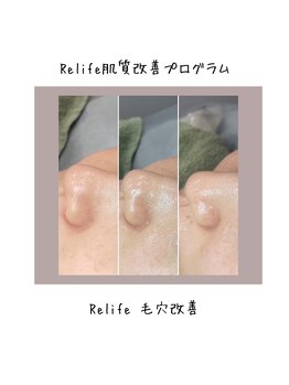 トータルビューティ リライフ(Total beauty Relife)/エクソソームと水素水ピーリング