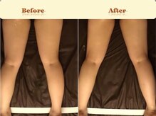 ビソウ(Biso)/キャビテーション