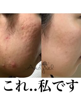 アンドピエル(AndPiel)/ニキビケアはお任せ下さい！