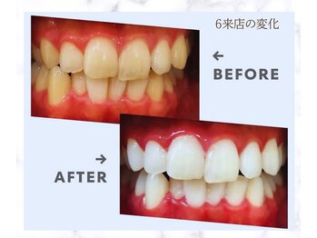 スマイルホワイト 赤羽店/ホワイトニングBefore After