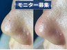 【モニター価格】毛穴エクストラクションがお得に受けれます！¥14,000→