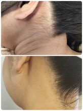 モモ(Momo.)/うなじ脱毛